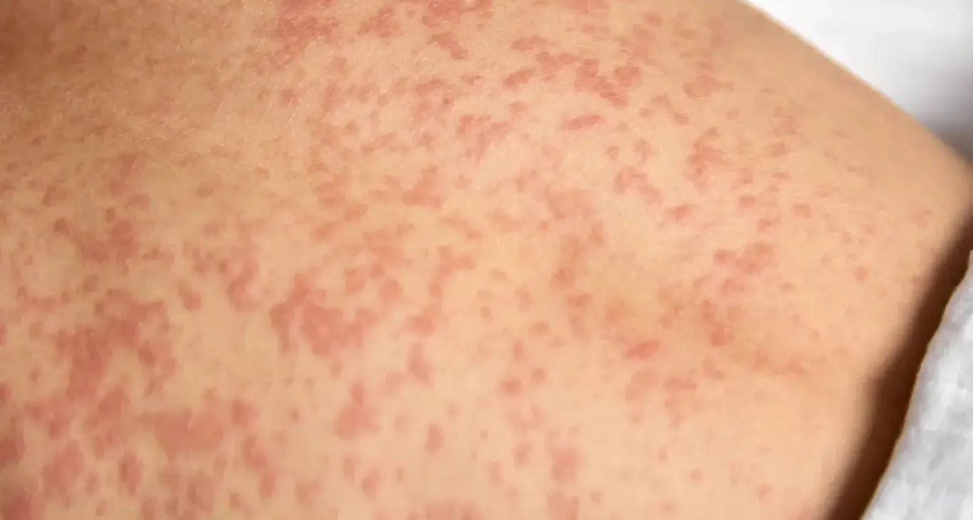 Community urged to check measles vaccination status